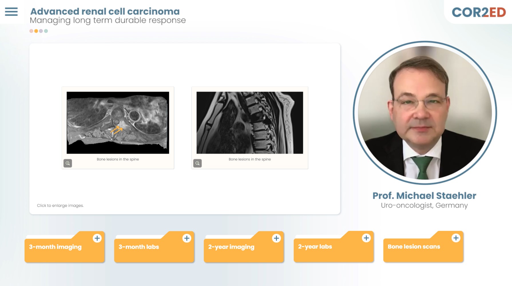 Advanced renal cell carcinoma: Managing a long-term durable response